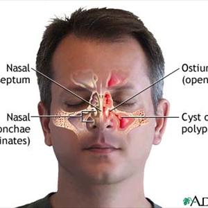 How To Improve Sinus - The General Look At And Medical Description Of Bronchiectasis