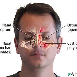  The General Look At And Medical Description Of Bronchiectasis