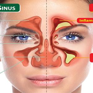  Basics As Well As Versions Of Sinus Irrigation