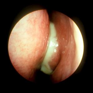 Antibiotics For Sinus Infection Rating - Treating Sinus Infections