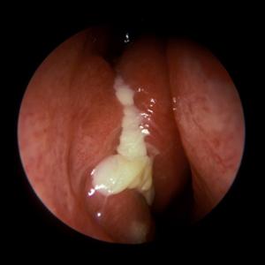 paranasal sinuses headaches