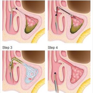 sinus cyst and cancer