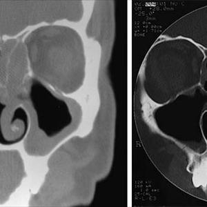  Balloon Sinuplasty Is Painless Innovative Technique To Conserve Nasal Hindrance