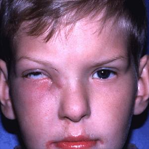 Sinus Problems Causing Swelling Of Eyes - Chronic Sinusitis In Children