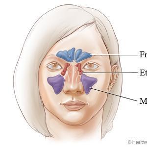 What Antibiotic Helps Sinus Infections - Why Will Sinusitis Produce Mucus?