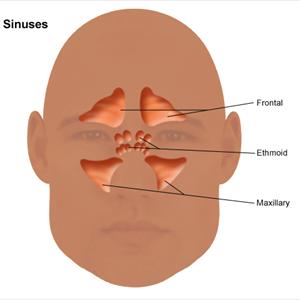 Does Nasalcrom Nose Spray Relieve Sinus Pressure - Some Sinusitis Organic Solutions