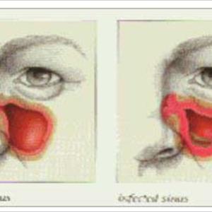 Dairy And Sinus Infections - Nasal Irrigation With Regard To Symptom Relief