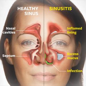 Viral Infection In The Nasal Passages - Medications In Which Permit Tinnitus