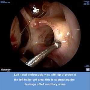 Does Horseradish Help Sinus - Balloon Sinuplasty - A Faster Way To Pay Off Sinuses!