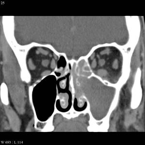 Dizziness Because Of Sinus - Treating Sinus Infections