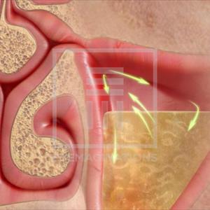 Deviated Septum Natural Treatment 