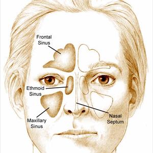 Sinus Infection Nasal Won