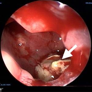 Sinuvil Herbals - Types Of Candica Sinusitis