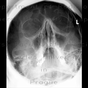 Fungal Infection In The Sinuses - The Sinusitis Remedy For Many Types