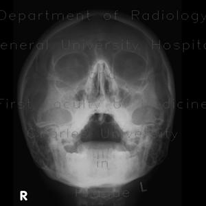 Impacted Sinuses 