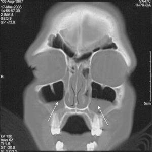 Sinitus Cure - Sinus Pressure Symptoms You Ought To Recognize