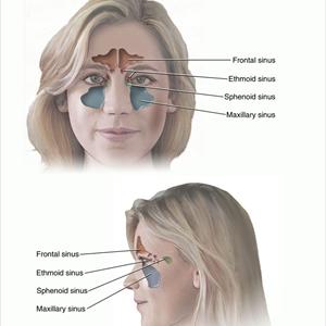 Sinus Fungus Symptoms - Advantages Of Topical Therapy Regarding Sinusitis And Rhinitis Treatment