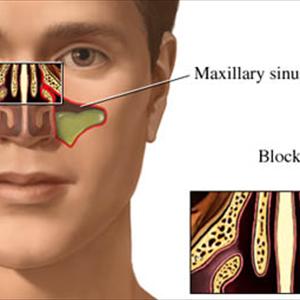 Retention Cyst In Frontal Maxillary Sinus - Home Fix For Sinus Infections