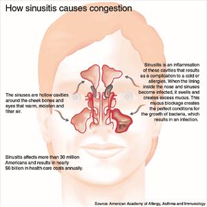 Sinusitis Herbal Treatments 