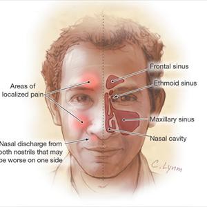 Home Remedy To Decongest Sinus - Sinusitis Information And Sinusitis Help With Regard To You
