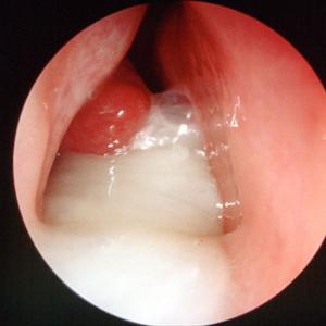 Antiinflammatories To Treat Sinus Issues - Sinus Surgery In India With Mumbai And Delhi At Inexpensive Cost