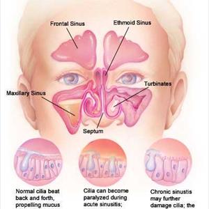  Sinusitis 