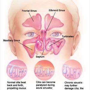 Nasal Inflammation - What Leads To A Sinus Infection