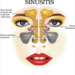 Natural Cures Chronic Mucous Disease - Inflammation With The Sinuses