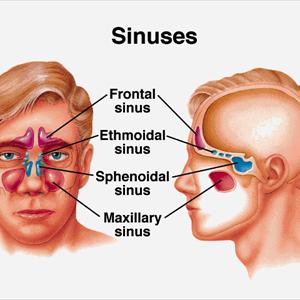 Cough With Phlem - Balloon Sinuplasty - Complete Solution For Sinus