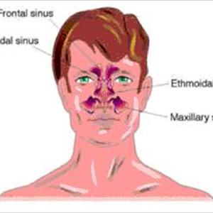  Search: How To Find Sinus Infections Tips