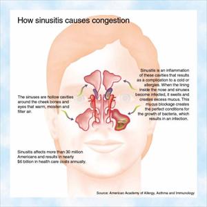 Sugar Causing Sinus Inflammation 